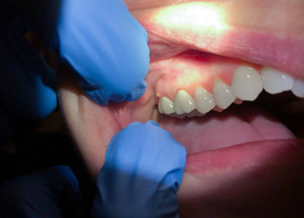 Best Emergency Broken Tooth Repair in North Lynnwood, WA